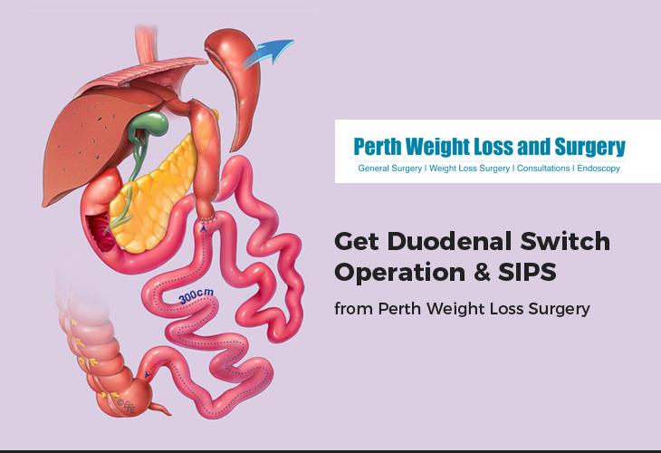 Get Duodenal Switch Operation & SIPS from Perth Weight Loss Surgery