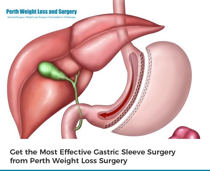 Get the Most Effective Gastric Sleeve Surgery from Perth Weight Loss Surgery