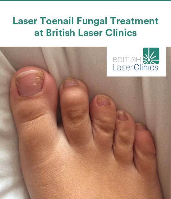 Laser Toenail Fungal Treatment at British Laser Clinics
