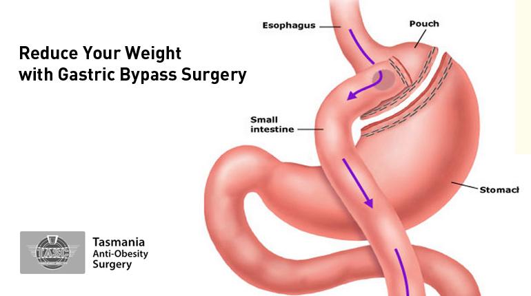 Tasmania Anti-Obesity Surgery - Reduce Your Weight with Gastric Bypass Surgery