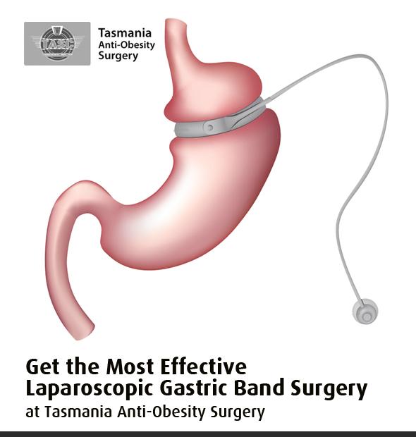 Get the Most Effective Laparoscopic Gastric Band Surgery at Tasmania Anti-Obesity Surgery