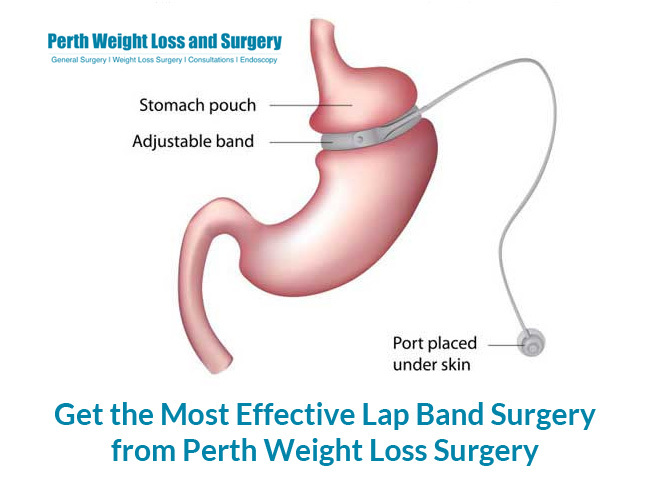 Get the Most Effective Lap Band Surgery from Perth Weight Loss Surgery