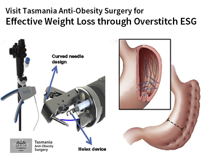 Visit Tasmania Anti-Obesity Surgery for Effective Weight Loss through Overstitch ESG