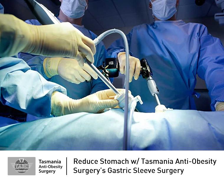 Reduce Stomach w/ Tasmania Anti-Obesity Surgery’s Gastric Sleeve Surgery