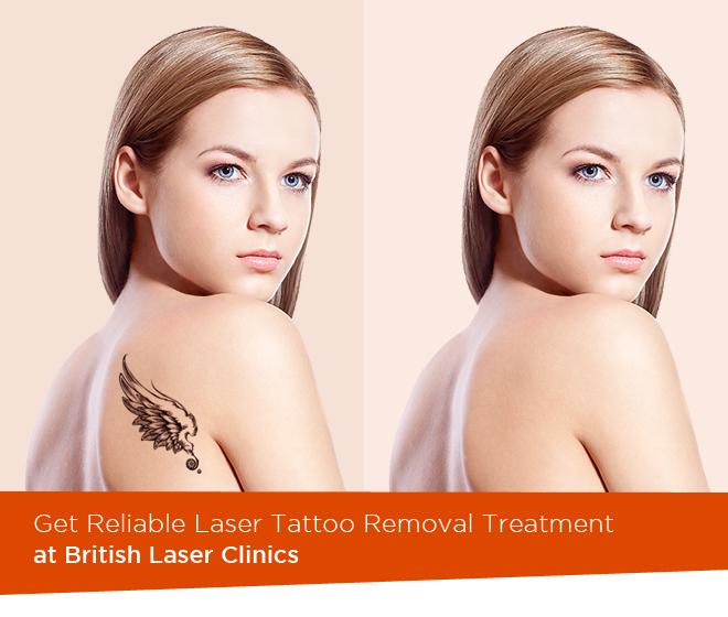 Get Reliable Laser Tattoo Removal Treatment at British Laser Clinics