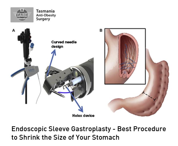 Endoscopic Sleeve Gastroplasty - Best Procedure to Shrink the Size of Your Stomach