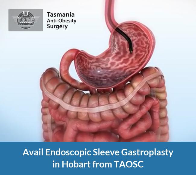 Avail Endoscopic Sleeve Gastroplasty in Hobart from TAOSC