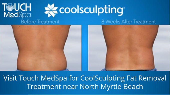 Visit Touch MedSpa for CoolSculpting Fat Removal Treatment near North Myrtle Beach