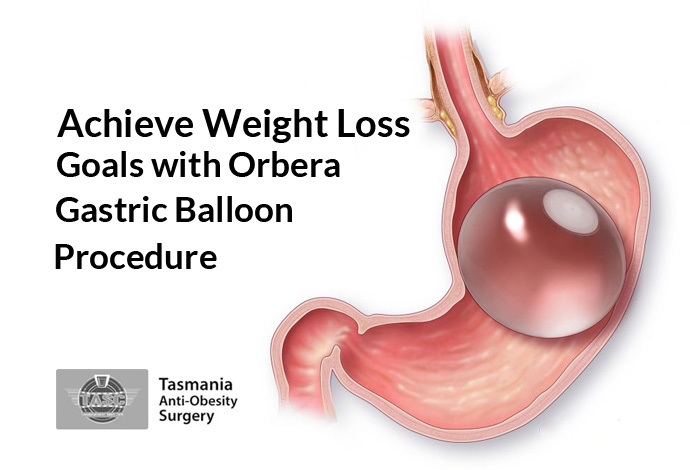 Achieve Weight Loss Goals with Orbera Gastric Balloon Procedure