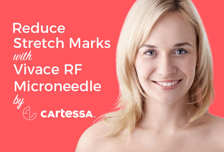 Reduce Stretch Marks with Vivace RF Microneedle by Cartessa Aesthetics