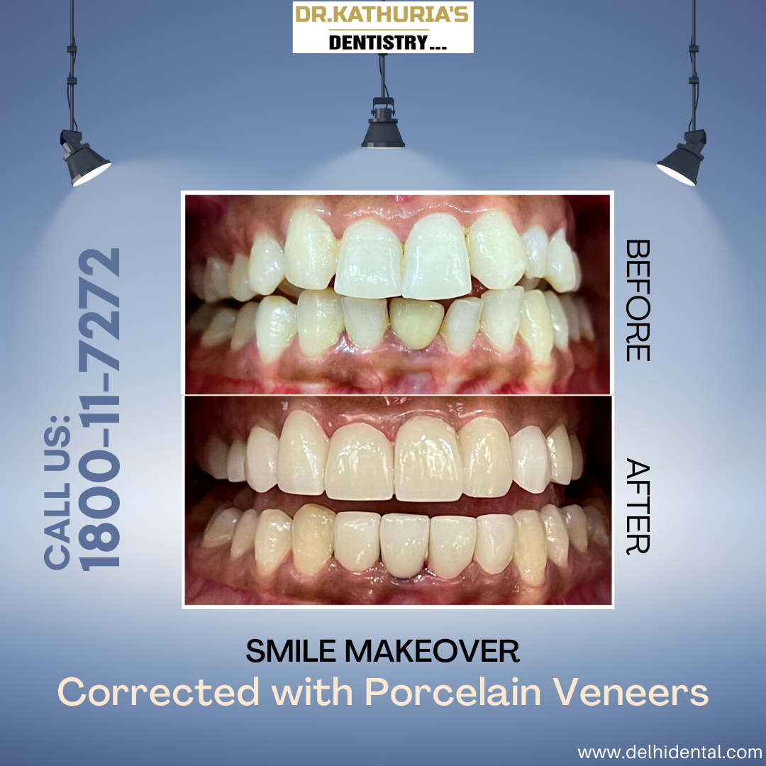 Smile Makeover with Porcelain Veneers.