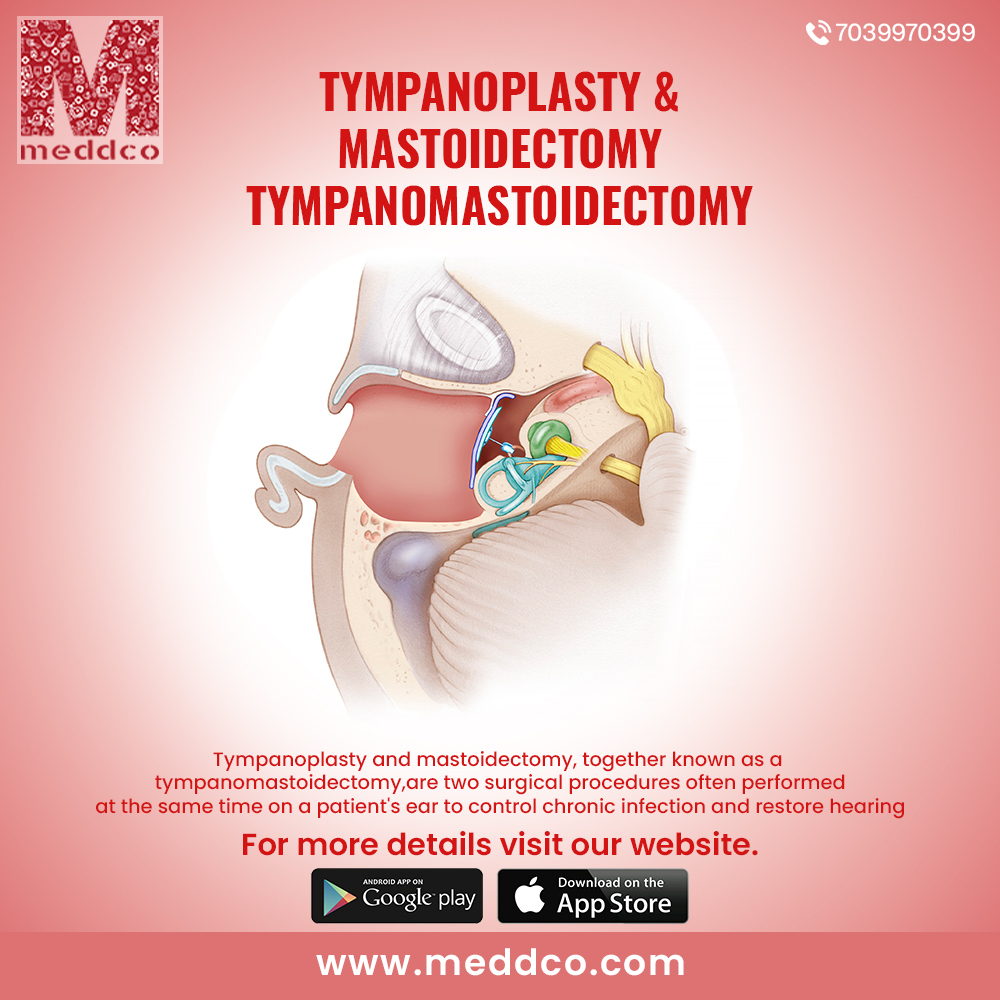 Tympanoplasty and Mastoidectomy Tympanomastoidectomy - Meddco