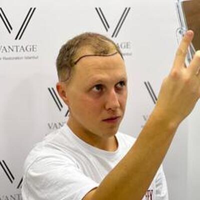 Vantage Hair Restoration Clinic
